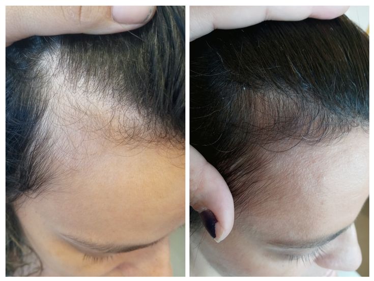 alopecia