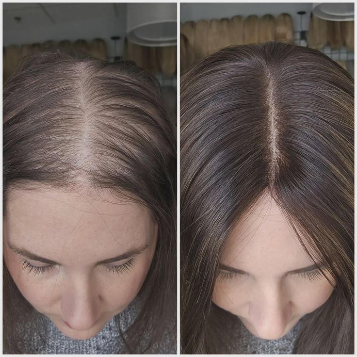 caida de pelo